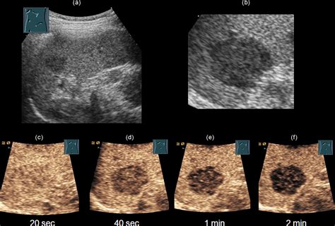 Contrast Enhanced Ultrasound Of Splenic Lymphoma Involvement European