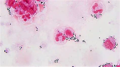 Pathology Outlines Streptococcus Pneumoniae