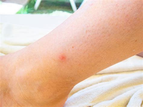 Bug Bite Insect Human Skin Allergy Stock Photos Pictures And Royalty