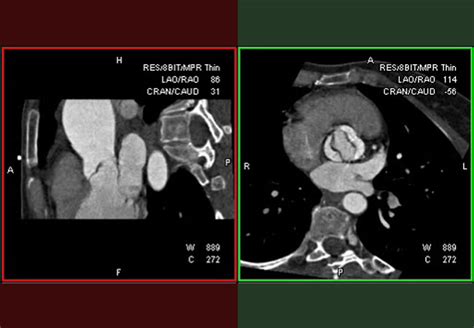 Multimodality Imaging Of The Bicuspid Aortic Valve Echo And Beyond Consult Qd