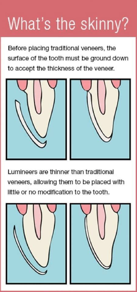 Crest.com has been visited by 10k+ users in the past month How Much Do Lumineers vs. Veneers Cost? | Veneers teeth cost, Veneers cost, Veneers teeth