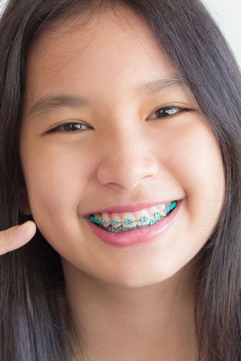 Pin By John Beeson On Girls In Braces In Orthodontic Treatment