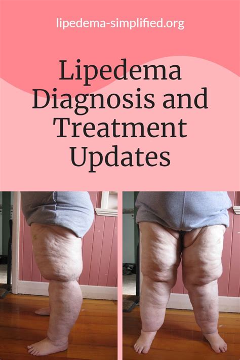 Understanding Fibrosis In Lipedema Inflamed Subcutaneous Adipose Tissue