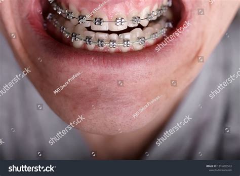 Metal Orthodontic Braces On Crooked Ugly Stock Photo 1316700563