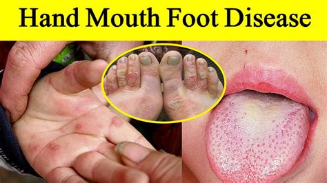 Hand Mouth Foot Disease How To Prevent Hand Foot And Mouth Disease