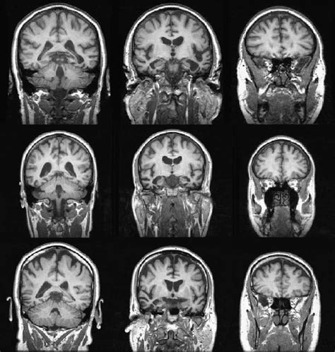 Typical Structural Brain Abnormalities Found In The Patient Population