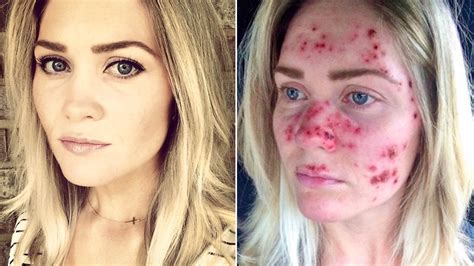 Womans Skin Cancer Selfies Go Viral — And Inspire Skin Checks Allure