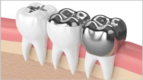 What is the history of amalgam? NGO releases briefing about phasing down dental amalgam