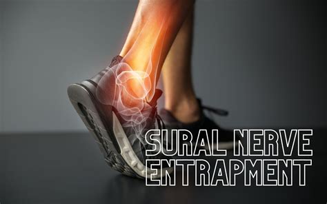 Sural Nerve Entrapment London Neurosurgery Spine Surgery