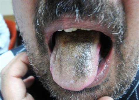 Elongated Papillae On The Tongue
