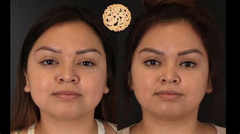 Buccal Fat Removal Before And After Drnazarian Md