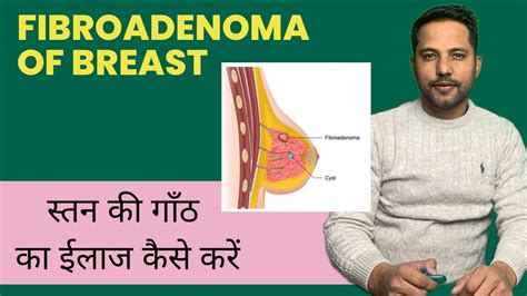 How To Treat Fibroadenoma And Fibroadenosis What You Need To Know