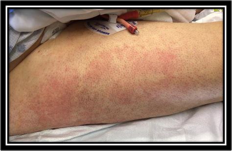 Rash Non Specifical Blanching Erythematous Rash On The Lower Download Scientific Diagram