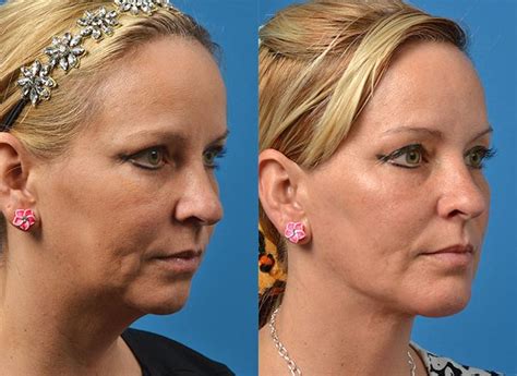 Patient 122406521 Laser Assisted Weekend Neck Lift Before And After