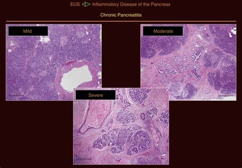Endoscopic Ultrasound In Inflammatory Diseases Of The Pancreas