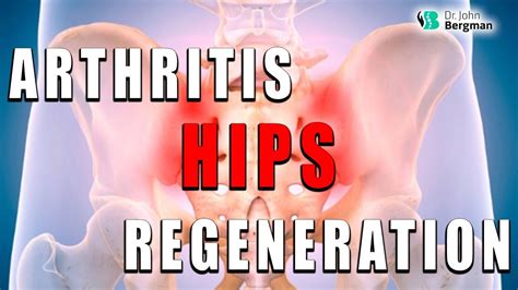 Hip Arthritis And Hip Regeneration Youtube