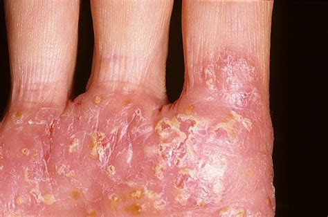 Microbial Eczema On Hands Pictures 54 Photos And Images