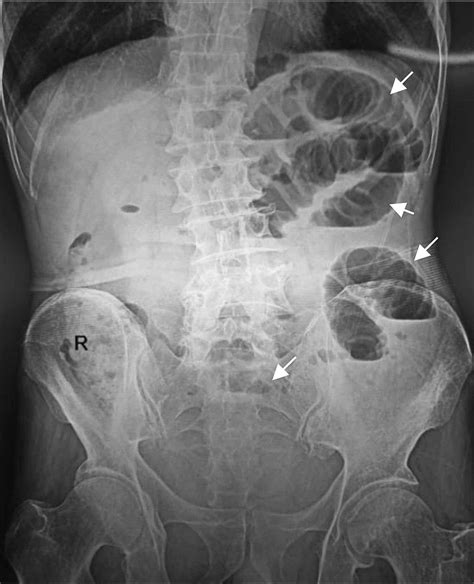 Cureus An Unusual Case Of Obturator Hernia Detected In An Elderly Man