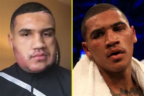 look boxer conor benn reveals crazy allergic reaction he had right before ko victory 15