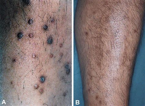 Perforating Folliculitis Report Of A Case In An Hiv Infected Man