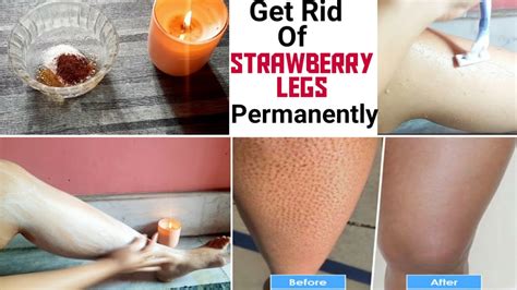 Strawberry Legs Removal🍓🍓 Strawberrylegs Skincare Youtube