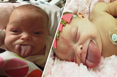 Baby Born With Adult Sized Tongue Smiles For First Time After Surgery