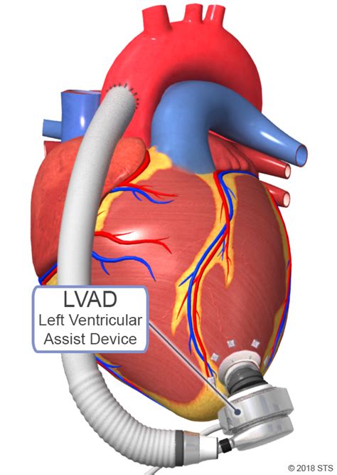 Left Ventricular Assist Device Lvad The Patient Guide To Heart