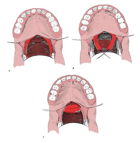 Pharyngeal Flap And Sphincter Pharyngoplasty Mpenta