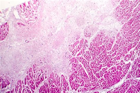 The term myocarditis refers to an inflammatory response within the myocardium that is not secondary to ischemic events or cardiac rejection in the setting of transplantation. Acute Myocardial Infarction Histology Of Heart Tissue ...