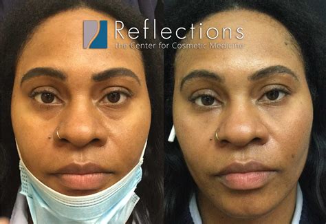 Under Eye Filler With Cheek Support Pre Treatment With Filler Before