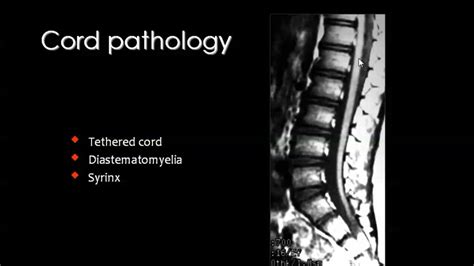 Pin by Dr abuaiad on spinal | Spinal cord, Spinal, Pathology