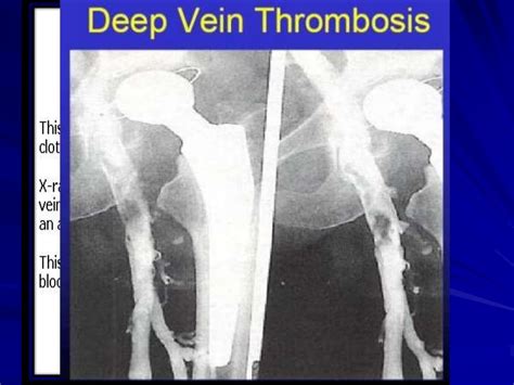 Deep Vein Thrombosis And Pulmonary Embolism 2014