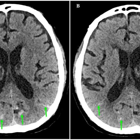 Axial Sections Of Non Contrast Brain Computed Tomography A