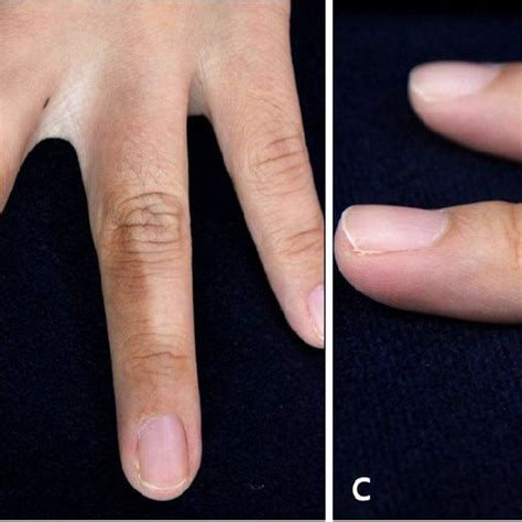 A Multiple Brown Pigmented Patches On The Left Hand B Homogeneous