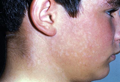 Tinea Versicolor Treatment Pictures Causes Symptoms Prevention