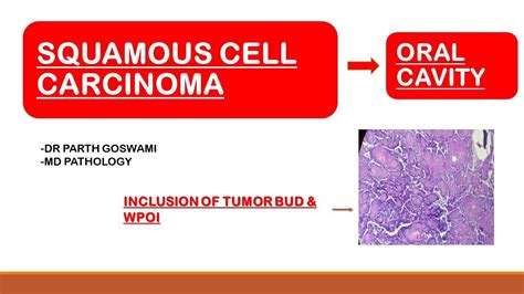 Squamous Cell Carcinoma Oral Cavity Youtube