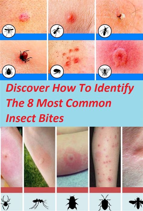 Discover How To Identify The Most Common Insect Bites With Images