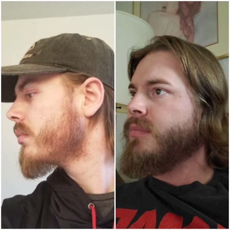 Patchy Beard Success Stories Before And After Photos Page 37 Beard Board