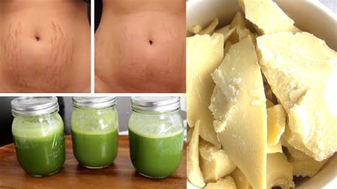 Get Rid Of Stretch Marks In Days At Home Natural Ayurvedic Home