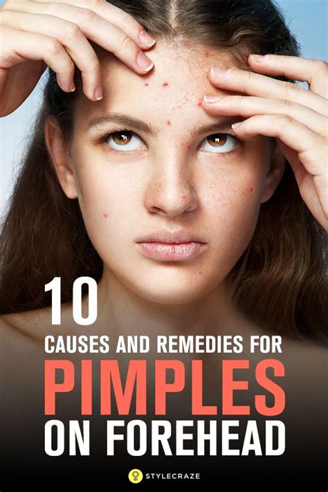 How To Get Rid Of Pimples On Forehead Pimples Remedies Pimples On