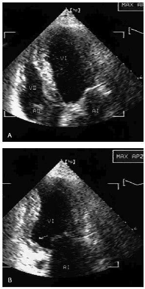 Left Ventricular Free Wall Rupture During Dobutamine Stress