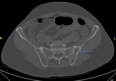 Axial Ct Scan Demonstrates A Geographic Osteolytic Lesion Of The