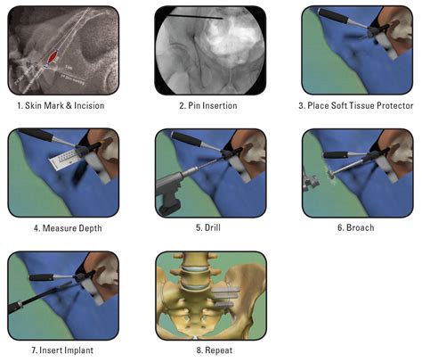 Implant Sacroiliac Joint Hot Sex Picture