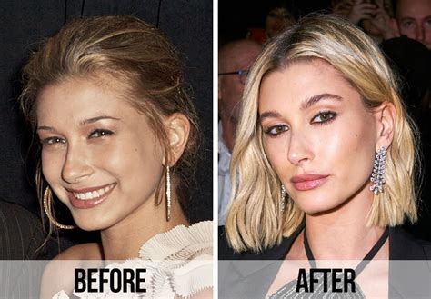 Fans Think Hailey Bieber Had A Nose Job And A Surgical Lip Flip After