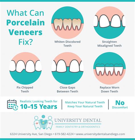 Everything You Need To Know About Porcelain Veneers University Dental