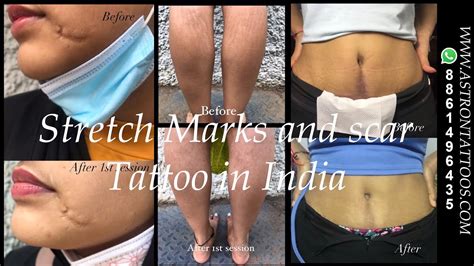 Skin Camouflage Or Scarstretch Marks Medical Tattoo In India