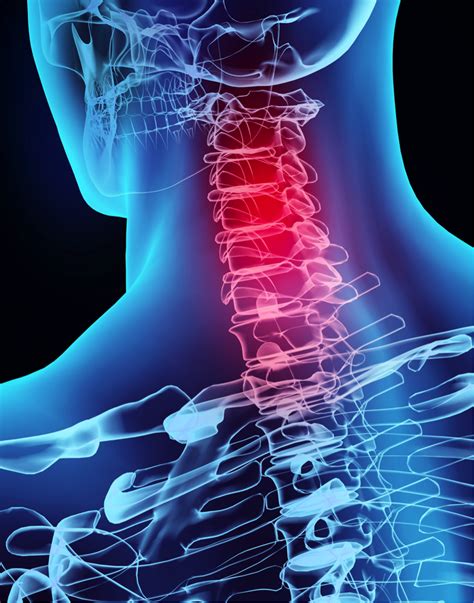 Cervical Radiculopathy Get Help At Turramurra Sports And Spinal Physio