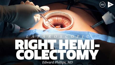Laparoscopic Right Colectomy By Edward H Phillips Md Case Trailer Youtube