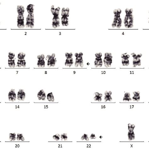 Karyotype Analysis Results Of The Patient After Initial Evaluation Of