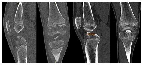 A 73 Year Old Girl With A Right Tibial Eminence Fracture Type Iv